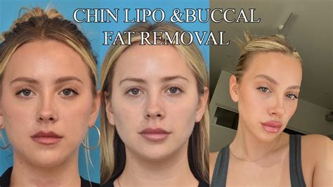 buccal fat removal youtube